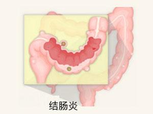 泉州结肠炎治疗需要花多少钱